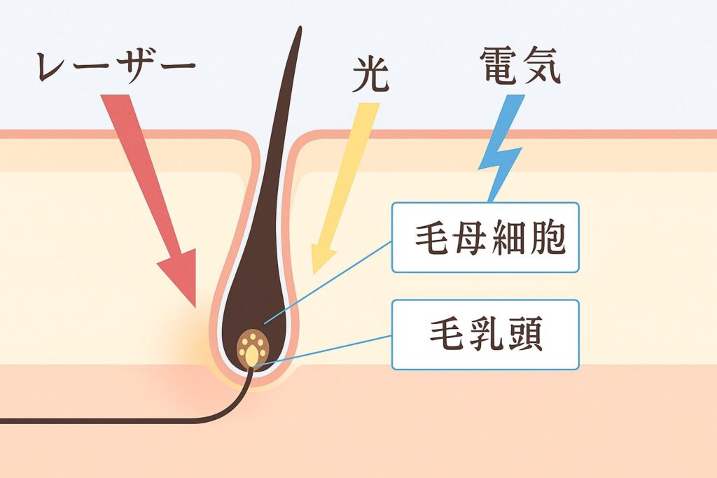 ヒゲ脱毛の仕組みを示す皮膚断面図。毛母細胞と毛乳頭にレーザーや光、電気が照射され、毛の根元にダメージを与える様子を図解。