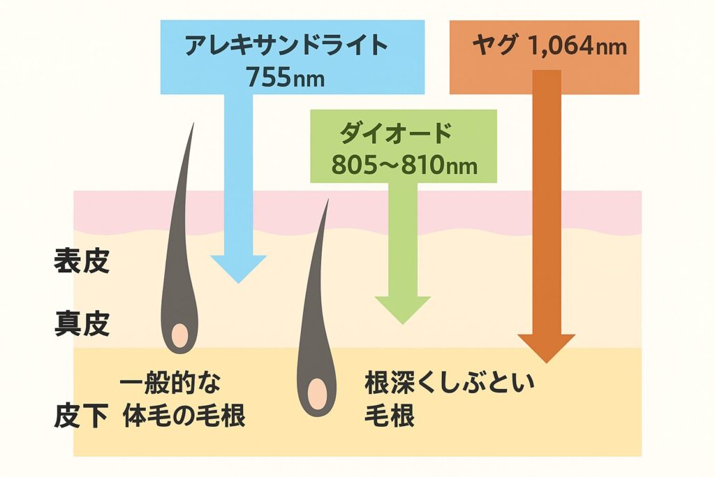 皮膚の断面図にレーザーの照射深さを示す図。アレキサンドライトレーザー(755nm)は真皮中層まで、ダイオードレーザー(805〜810nm)は真皮下層まで、ヤグレーザー(1064nm)は皮下脂肪まで到達する様子を示している