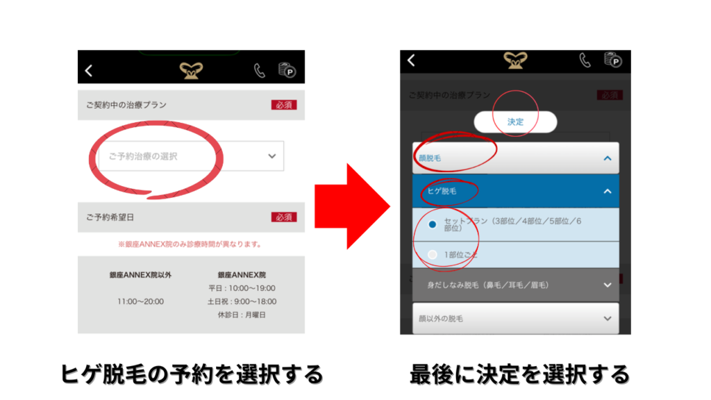 ヒゲ脱毛の予約プランを選択して決定する画面