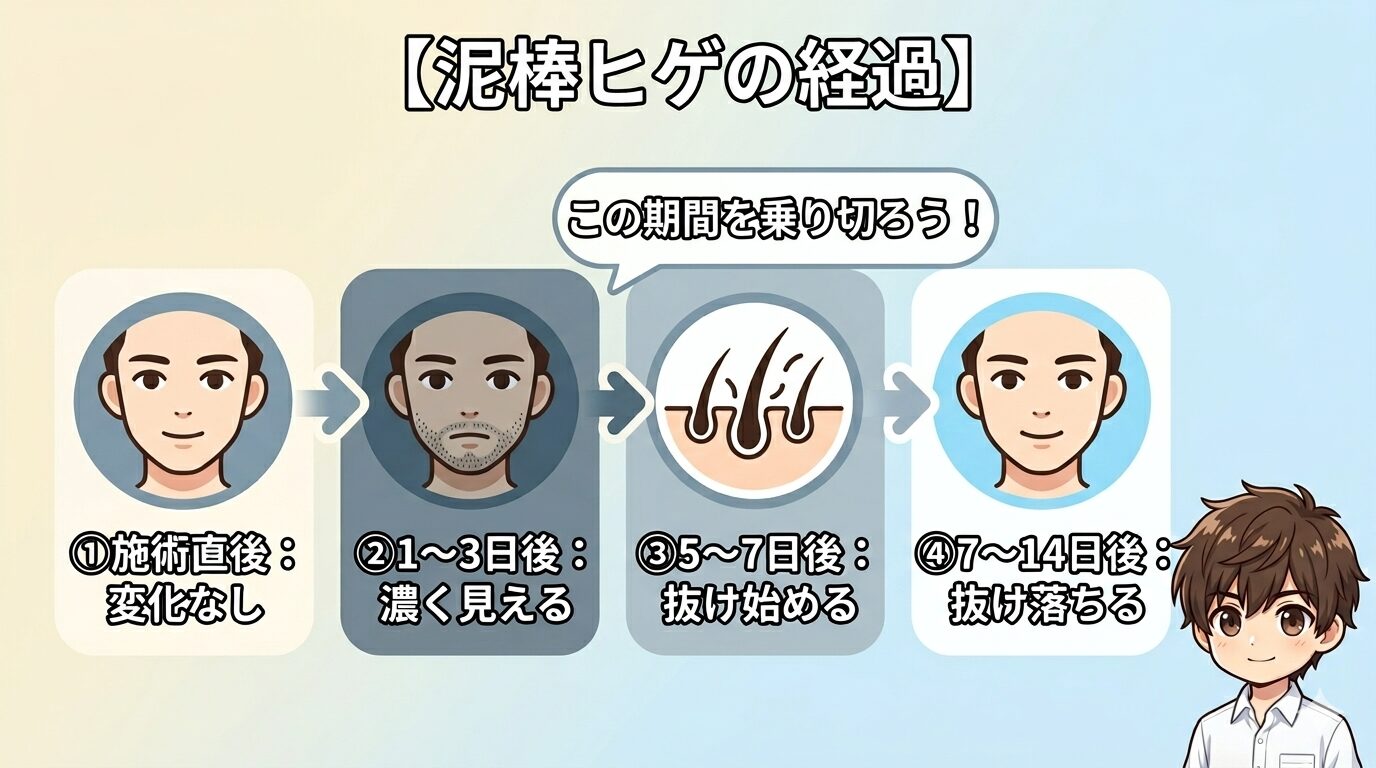 泥棒ヒゲの経過を4段階で示した図解（施術直後から抜け落ちるまで）